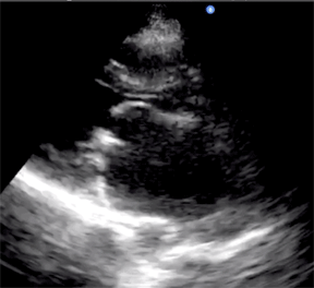animated Gif of ultrasound of a heart